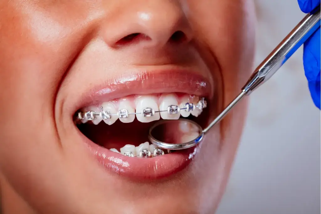 Can Braces Cause Cavities? What You Need to Know